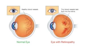 Diabetic retinopathy diagram