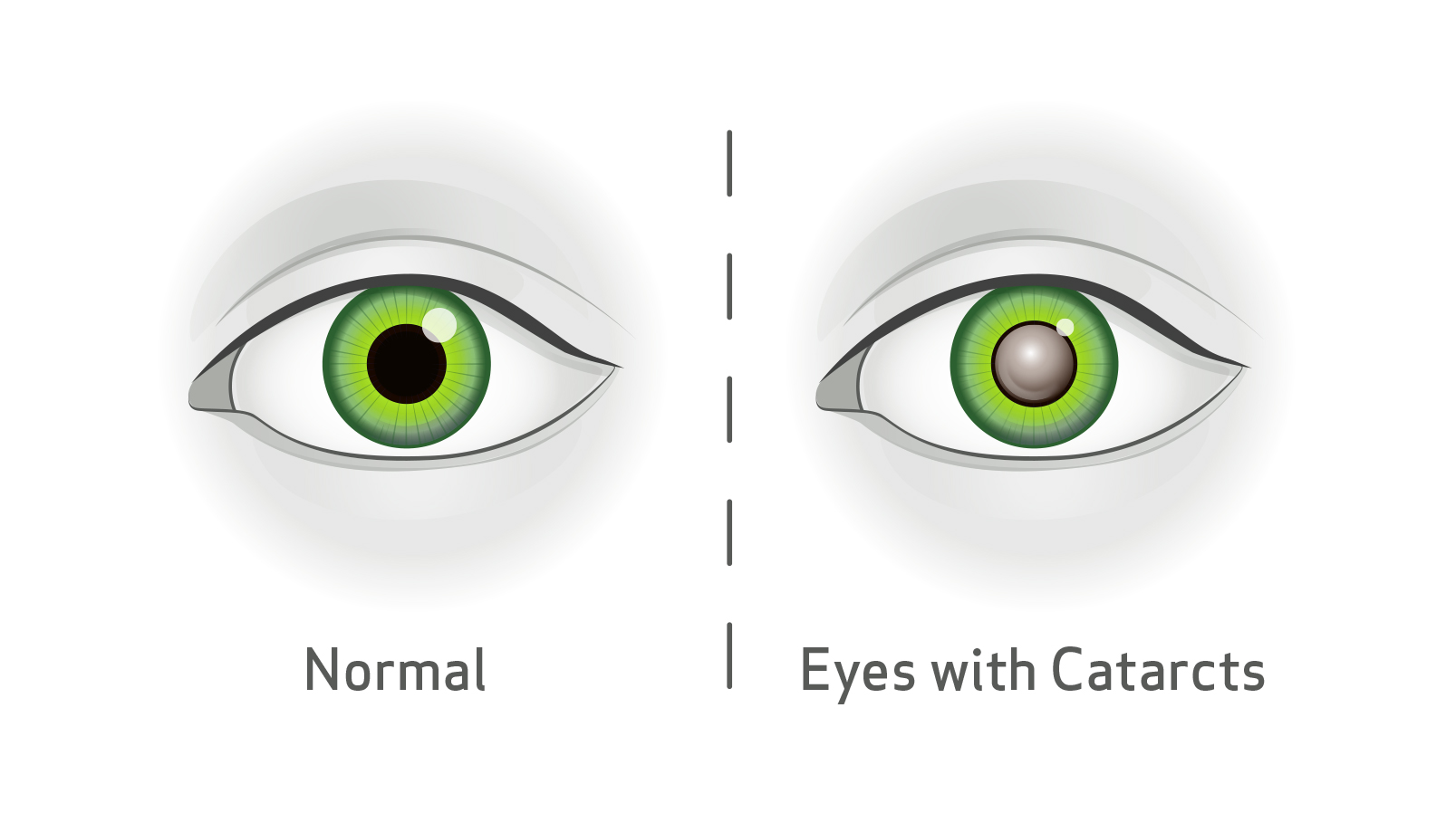 Blink Vision Cataract iagram, left showing normal eye, right showing eye with cataracts