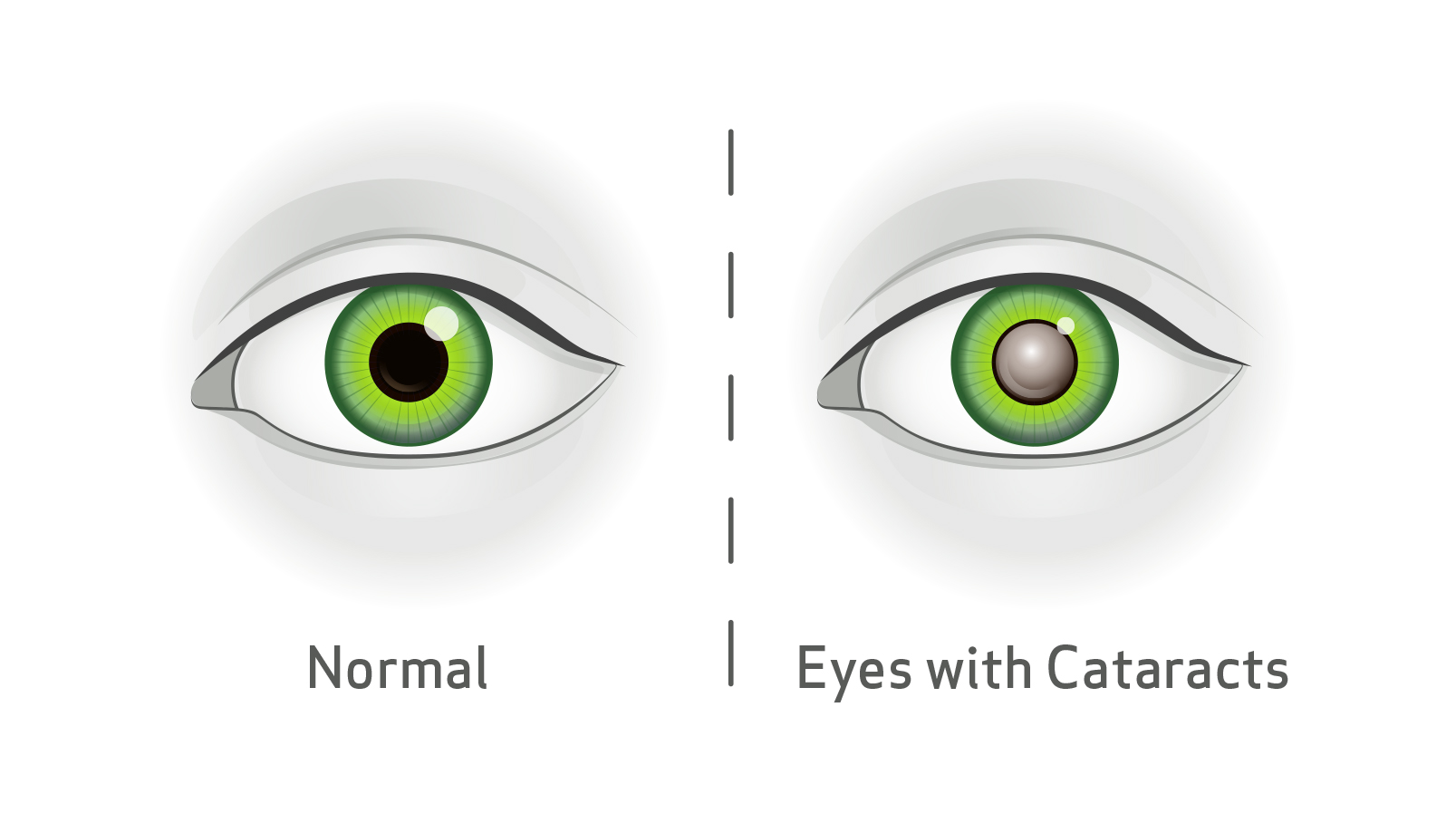 cataracts eye diagram